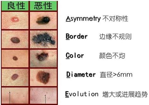 如何分辨痣的好壞|如何安全地除痣：医生教你辨别良性与恶性痣的方法